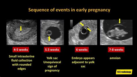early ultrasound dating pregnancy